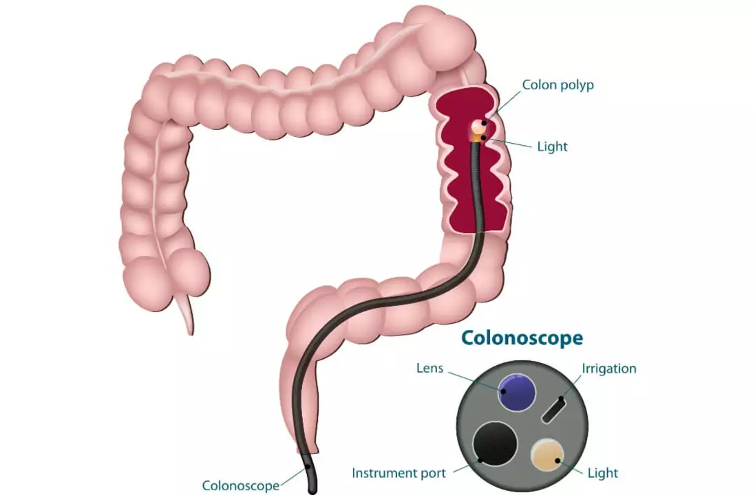 Comprendiendo el papel del colon en la diarrea crónica