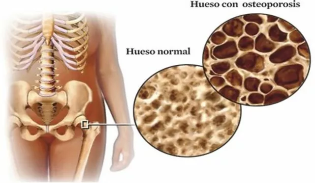 La conexión entre el acetato de ciproterona y la osteoporosis