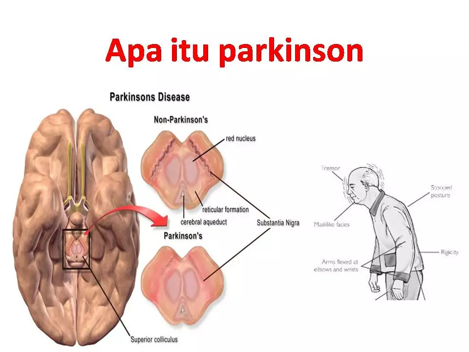 Rasagilina y Ejercicio: Una Combinación Poderosa para la Enfermedad de Parkinson